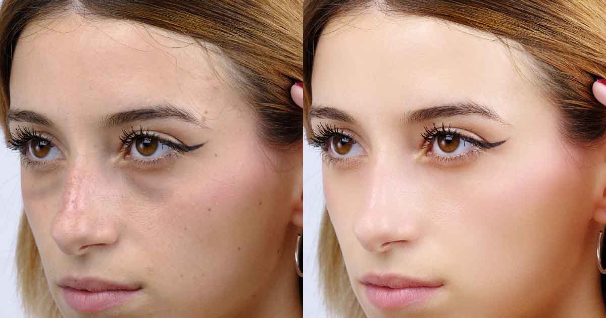 Eye-bag-removal